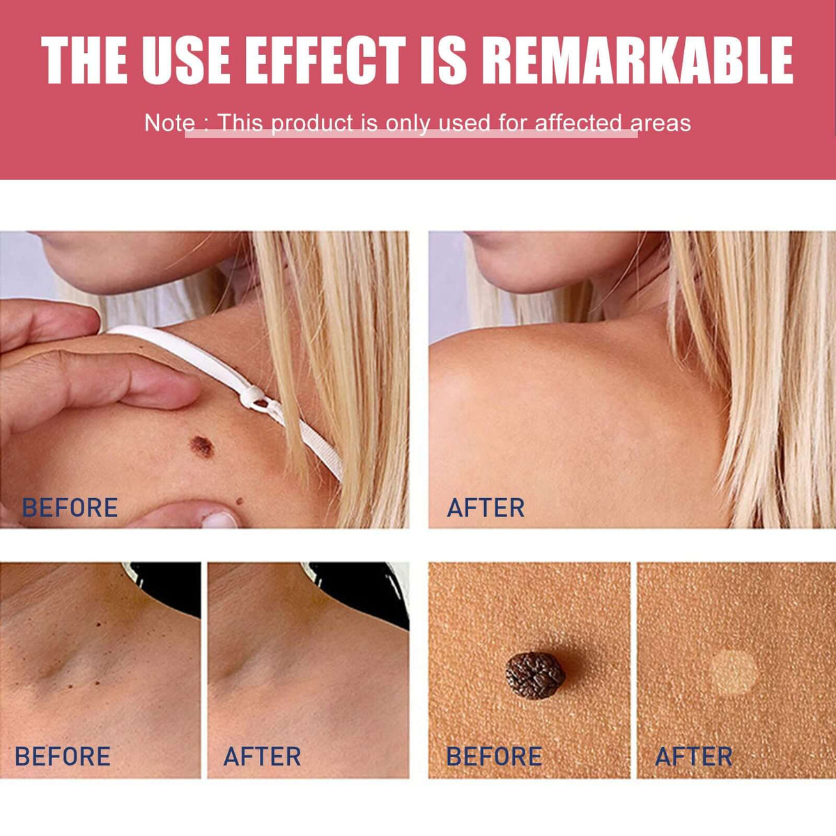 EELHOE Mole Removal Rose Oil Soap – Pain and Scar Free Formula | Phonax Services