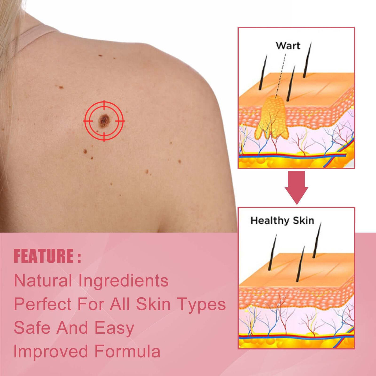 EELHOE Mole Removal Rose Oil Soap – Pain and Scar Free Formula | Phonax Services