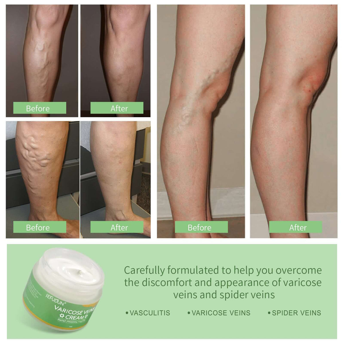 Varicose Vein Cream – Redness, Leg Fatigue & Pain Relief with Natural Herbal Ingredients | Phonax Services